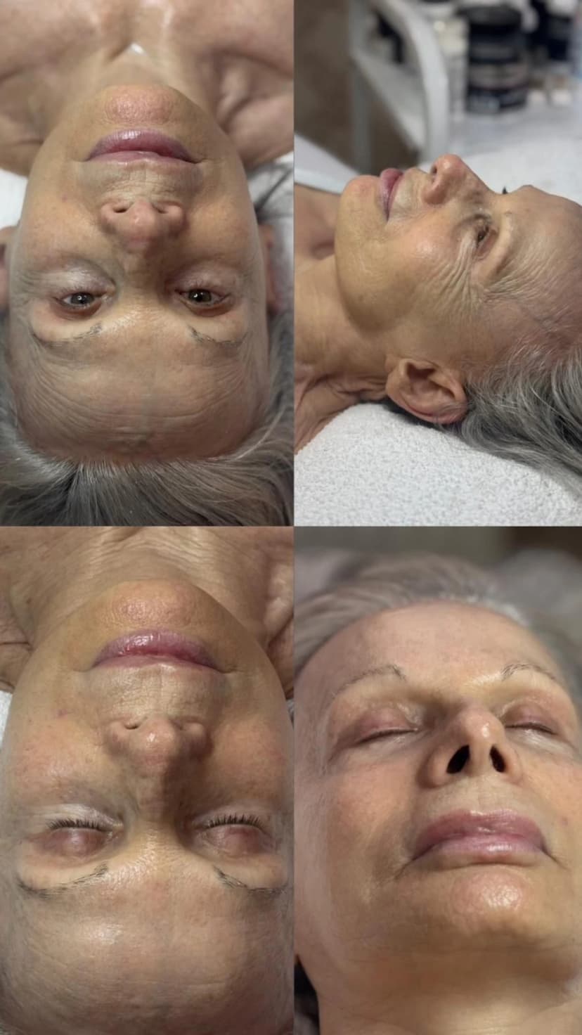 Ergebnis Microlifting