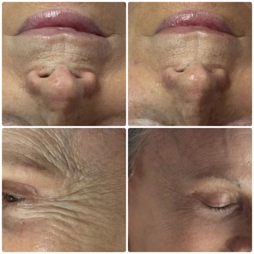 Ergebnis Microlifting