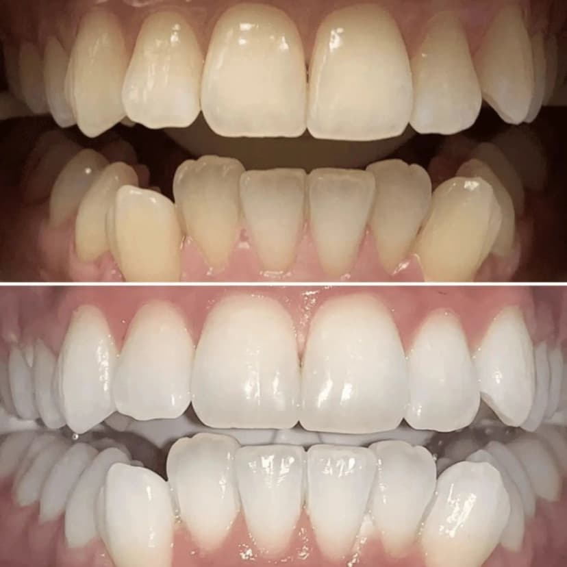 Ergebnis Zahnbleaching