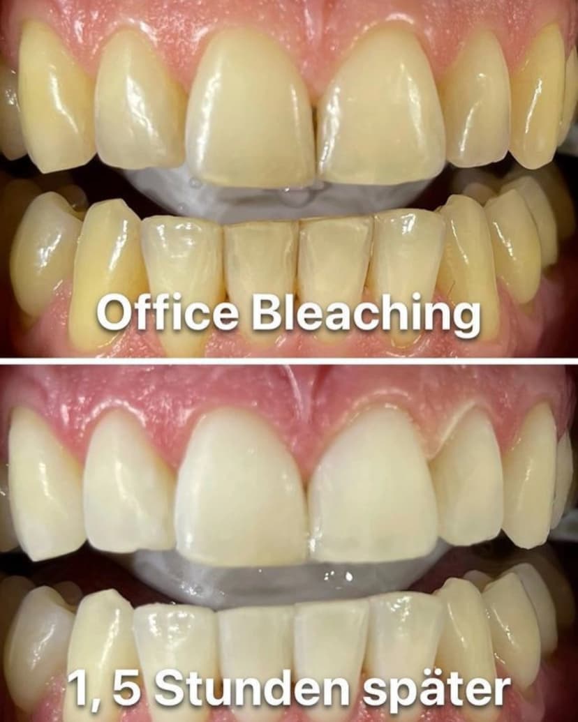 Ergebnis Zahnbleaching