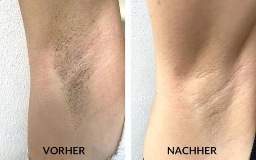 Ergebnis Laser-Haarentfernung