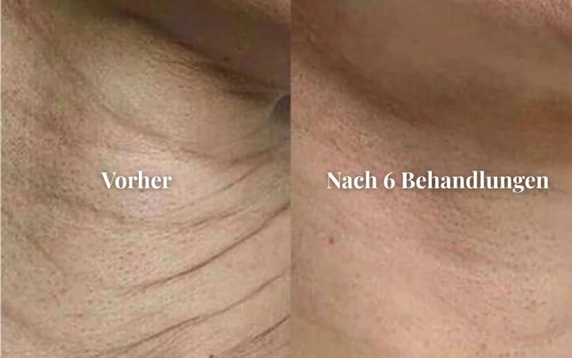 Ergebnis Gesichtsbehandlung