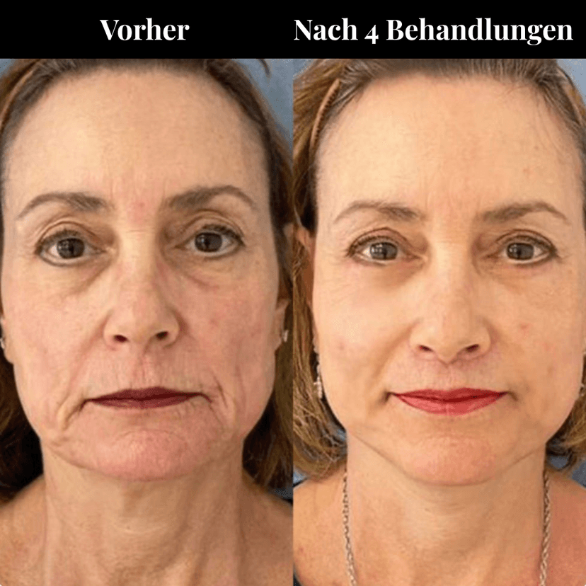 Skin tightening treatment